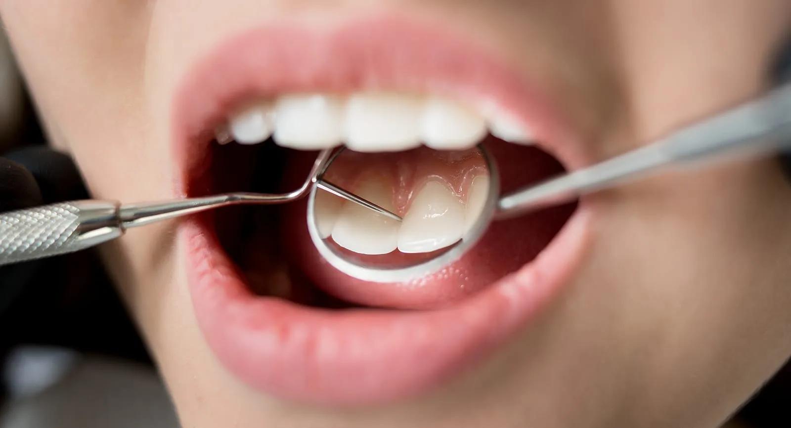 Why Bother with Regular Dental Visits?