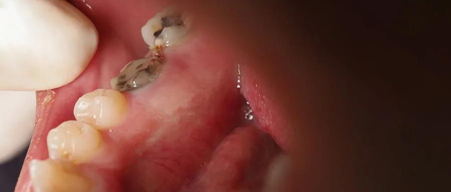What Is Tooth Decay and What Can I Do About it?