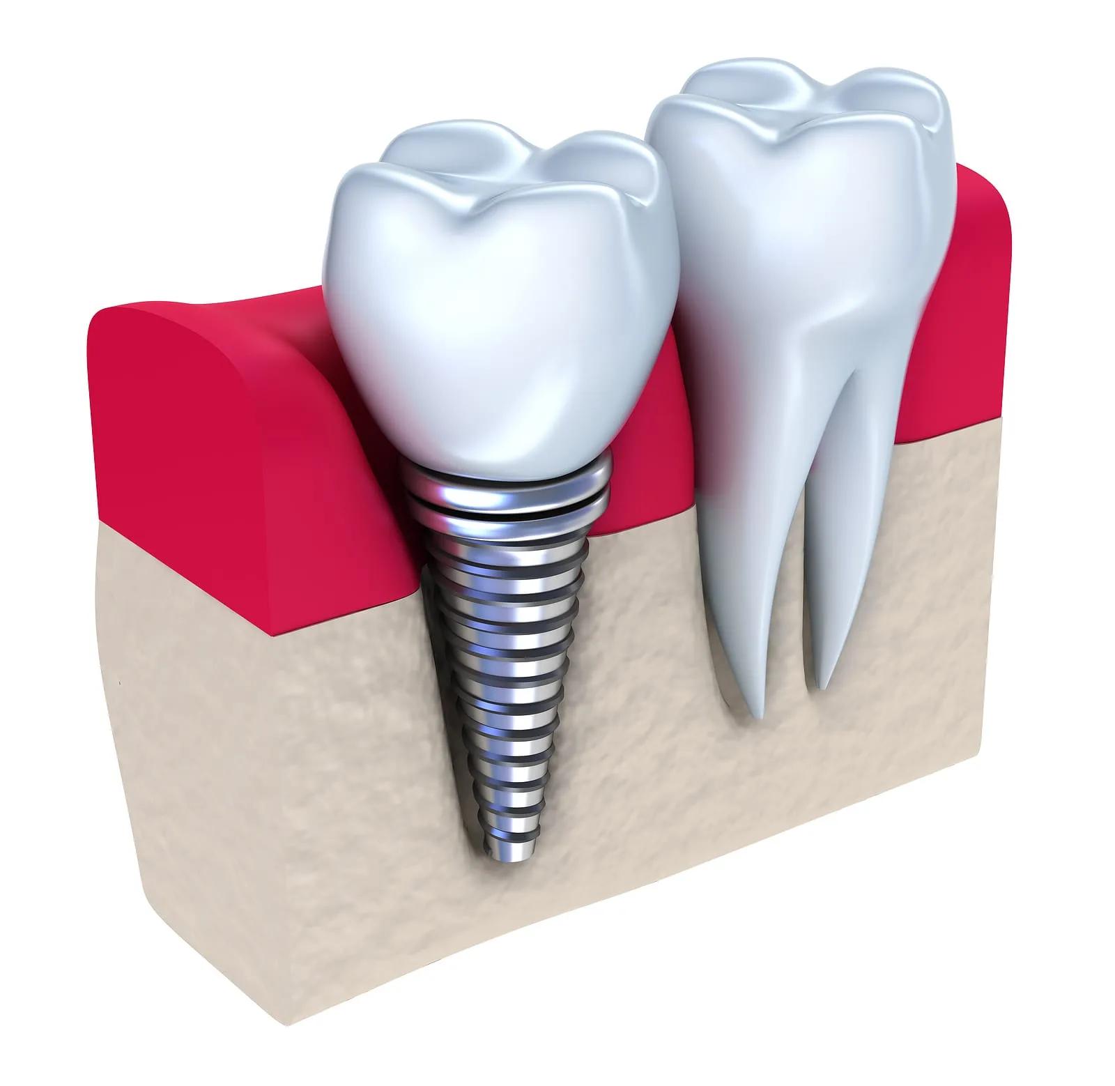 Restore Your Confidence with Dental Implants in Nottingham