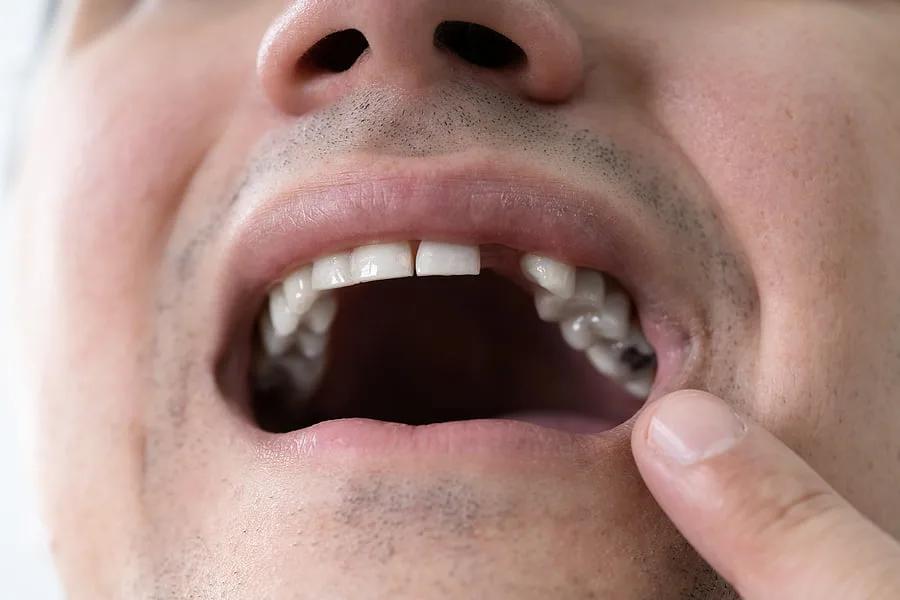 Why Do Implants Make The Best Replacements For Missing Teeth?