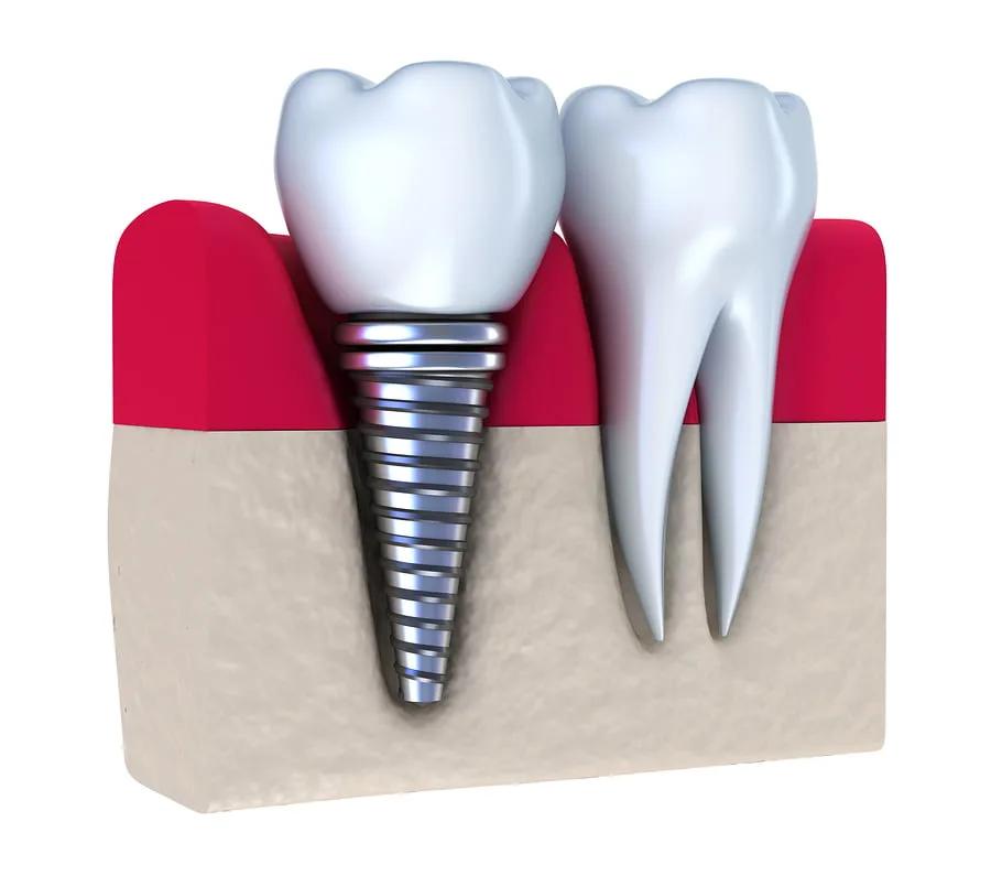 Dental Implants: Learn To Love Your Teeth and Smile Again