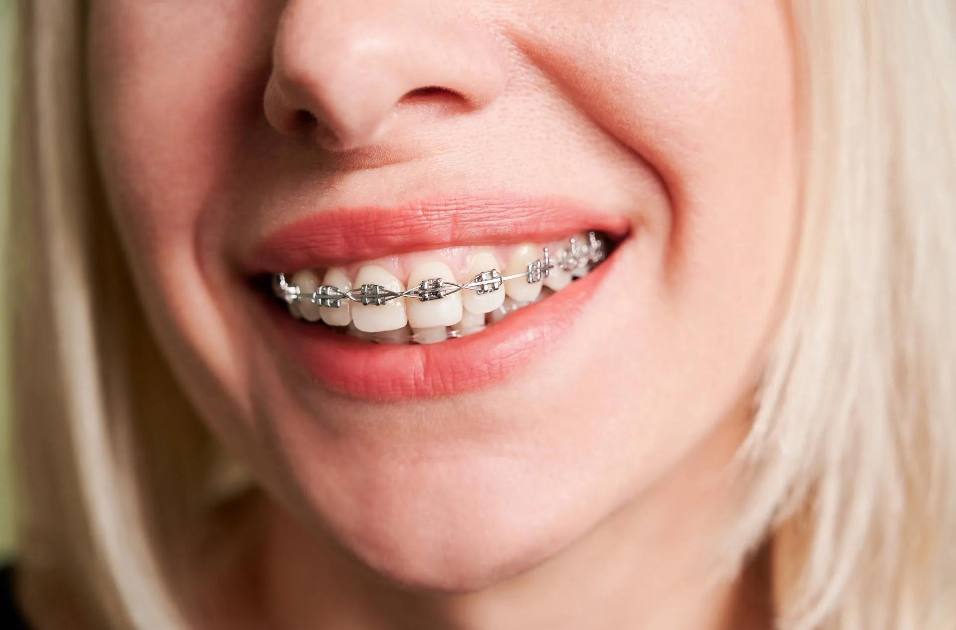 Orthodontic Treatment – Achieving More Than Just A Great Smile
