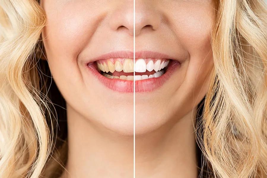 What’s The Safest Way To Whiten My Teeth?