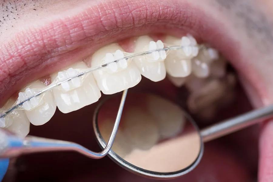 Should You Straighten Your Teeth With Invisalign Or Six Month Smiles?