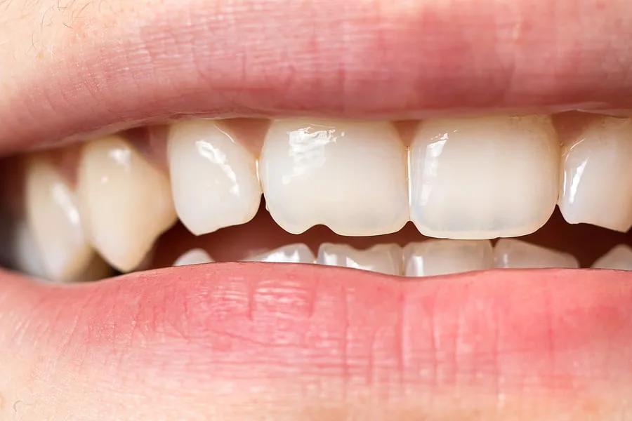 Chips, Cracks and Gaps: Why Choose Park Dental Care to Repair Your Teeth?