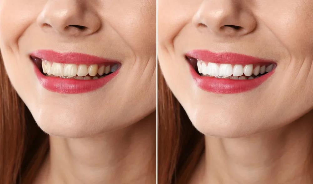 Brighten Your Smile in Just 3 Weeks with Enlighten Teeth Whitening in Nottingham