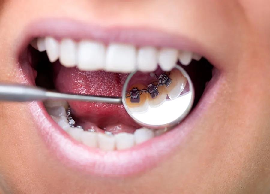 5 reasons to choose hidden braces