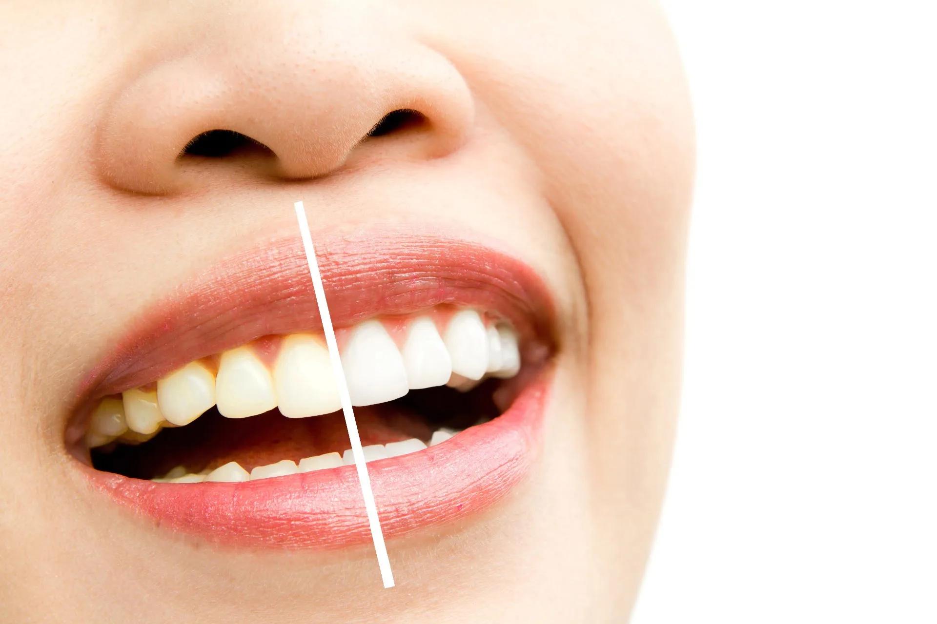 Teeth Whitening – How It Has The Potential To Be Life-changing