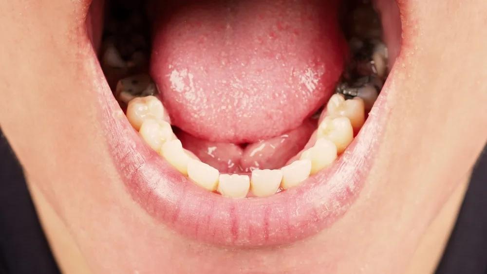 Can Tooth-Coloured Fillings Really Replace Silver Fillings?