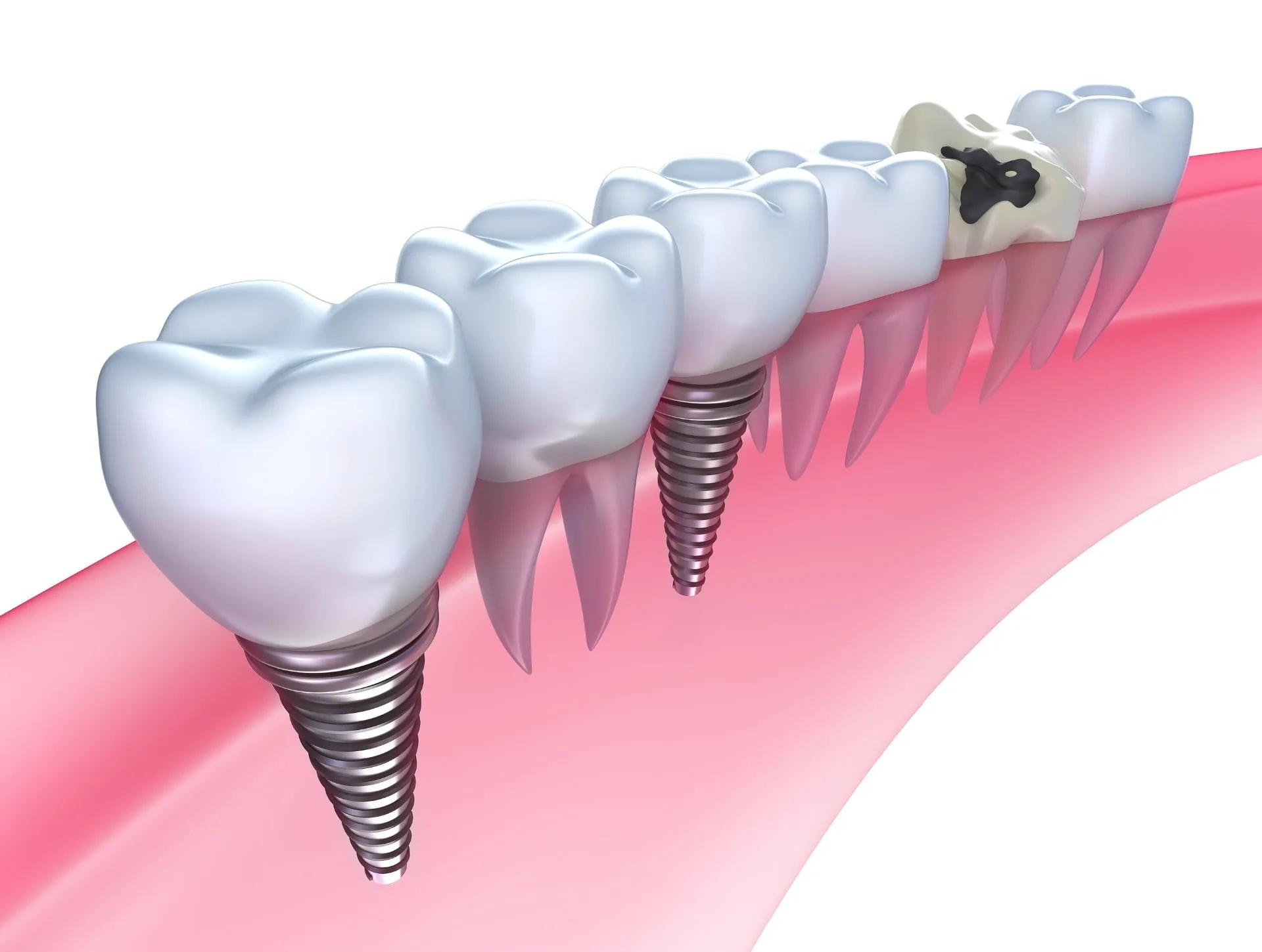 4 Reasons Why Dental Implants Are Incredible