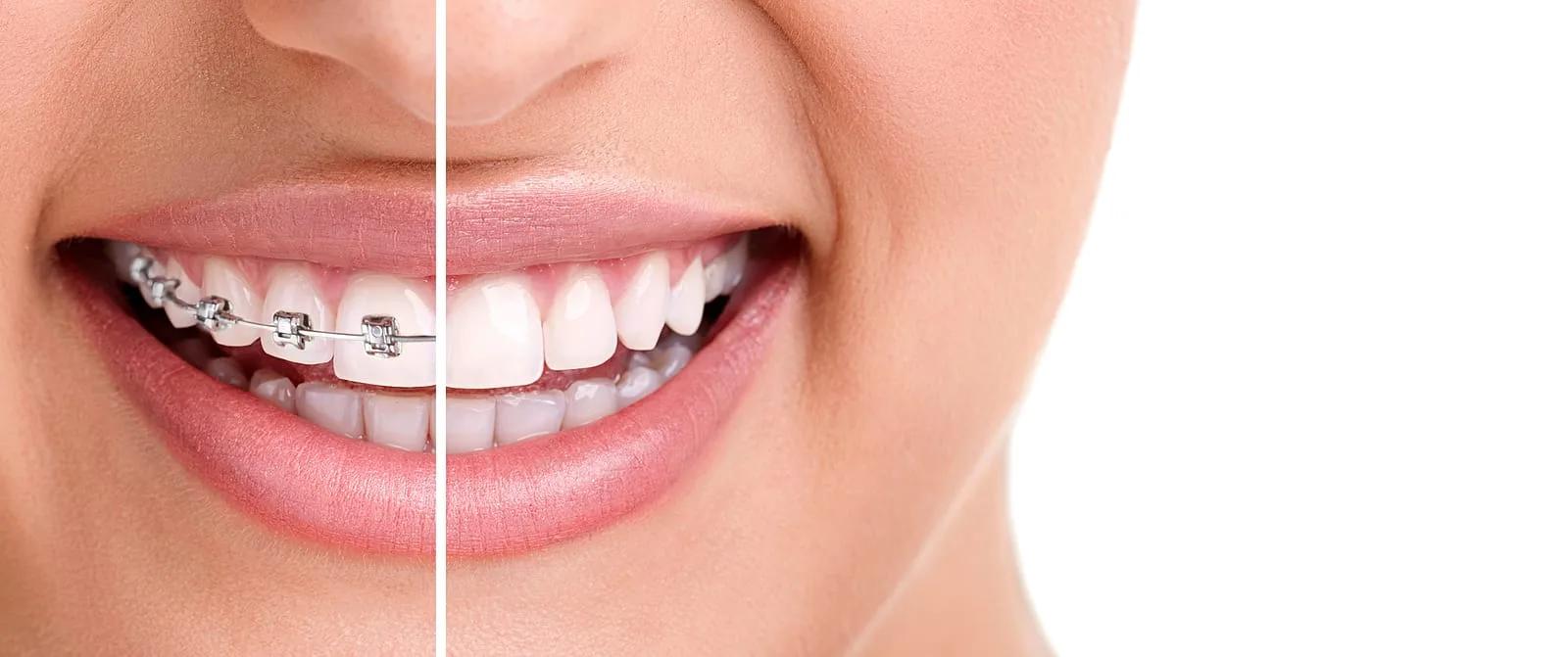 Transform Your Smile with Adult Braces in Nottingham