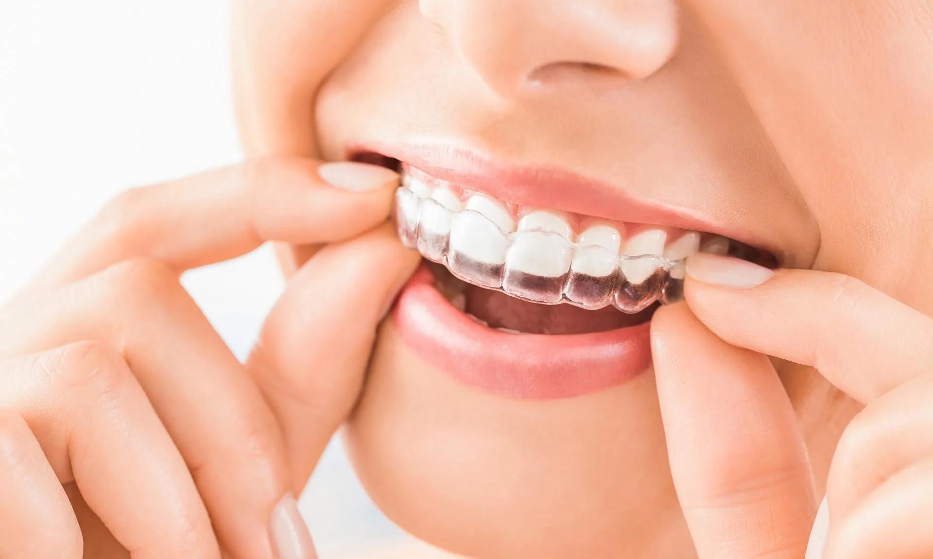 5 tips to keep your Invisalign aligners in top condition